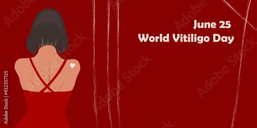 June 25 - World Vitiligo Day. Pigmentation disorders. Skin depigmentation. Vector illustration on the theme of rare diseases. Chronic skin disease