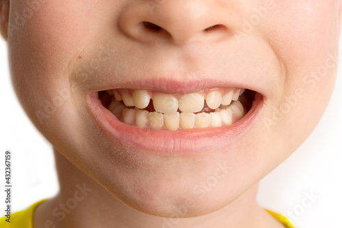 Little girl stands on a white background with a beautiful smile, children crooked teeth, pediatric dentistry. Crooked teeth close-up. Correction of malocclusion is required. photo