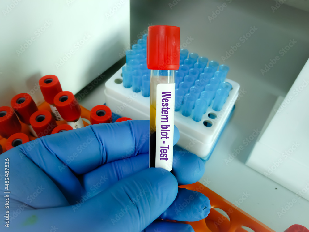 Blood sample tube for Western blot test, confirmatory test for HIV