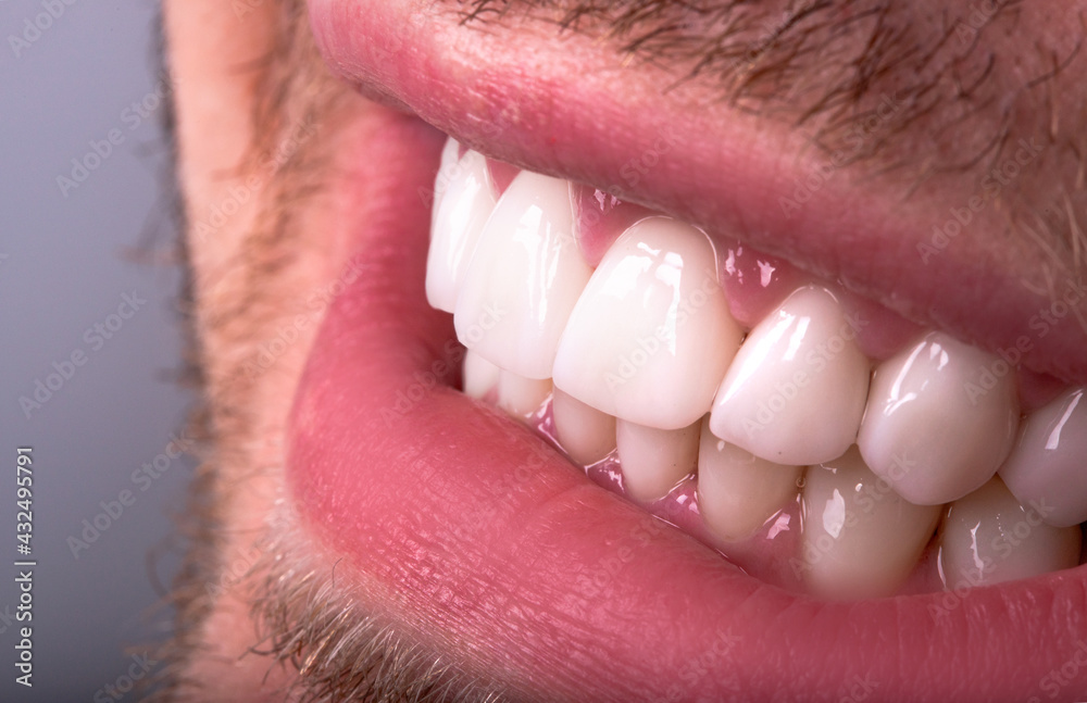 Obraz premium Perfect Close Up White beautiful Veneers Teeth bleaching crowns whitening young lady smiling, Male beard natural man smile. Dental zircon implants restoration surgery. Fashion concept