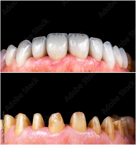 press ceramic crowns and veneers b2 color