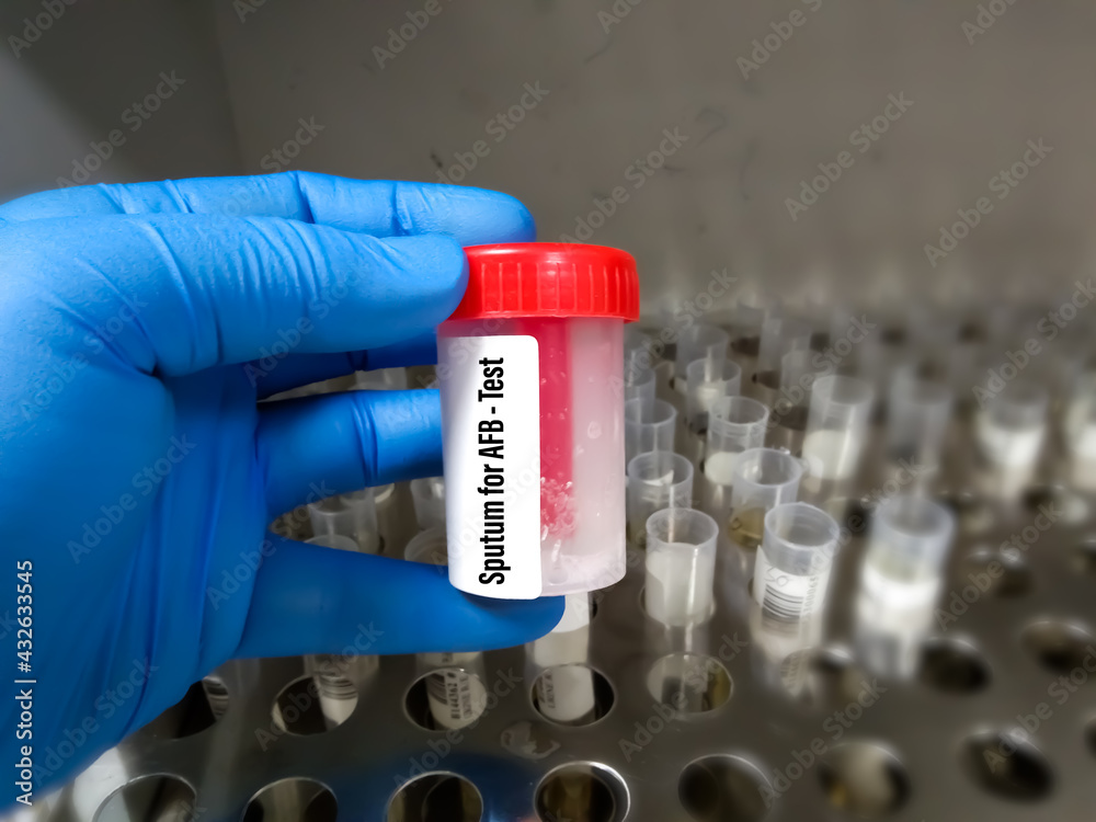Sputum sample container holding by doctor for AFB test. A Microscopic test for detecting