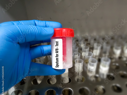 Sputum sample container holding by doctor for AFB test. A Microscopic test for detecting tuberculosis (TB) bacteria. photo