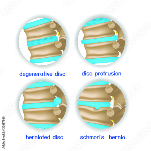 Spine diseases. Various pathologies of intervertebral discs and bones. 4 round icons. Vector illustration