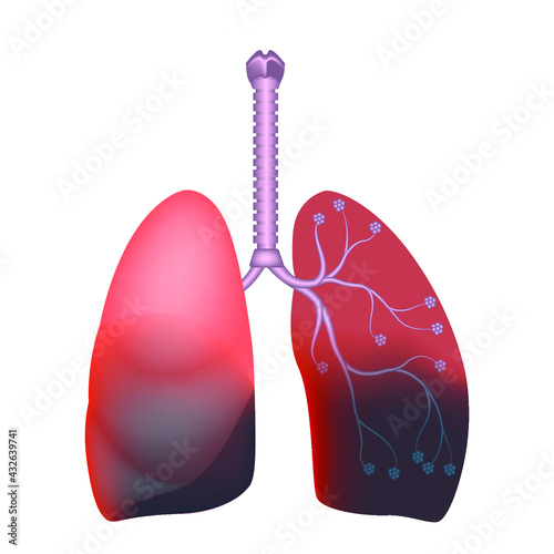 Bilateral pneumonia. Lung abscess. Infectious lesion. Vector illustration.