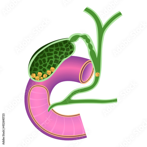 Gallstones. Chronic chrlecystitis. Digestive organs anatomy. Vector illustration.