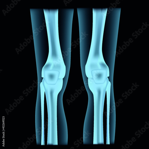 Human legs in x-rays. Knee joints. Skeleton structure. Vector illustration.