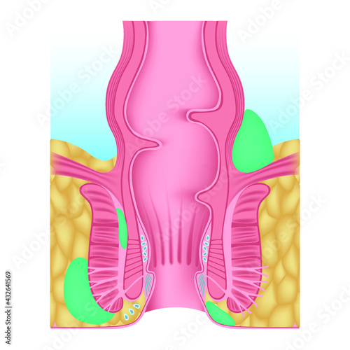 Anorectal abscess. Swelling near the anus. Inflammation of the anus and rectum. Disease of the glands. Accumulation of pus. Anatomy diagram of the anus. Vector illustration
