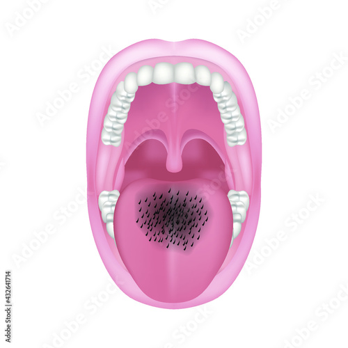 Glossite fleecy. Overgrowth of the papillae of the tongue with permanent trauma and candidiasis. Medical poster. Vector illustration