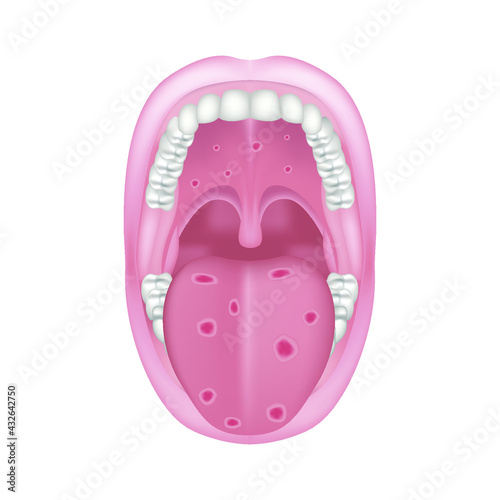 Oral syphilis. Venereal disease. Ulcers on the tongue and palate. Vector illustration