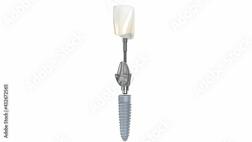 Ceramic crown, custom implant abutment and implantat instalation process. Medically accurate 3D animation. photo