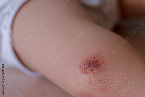 A close-up of a scabbed scab on the knee of a child caused by a fall accident.