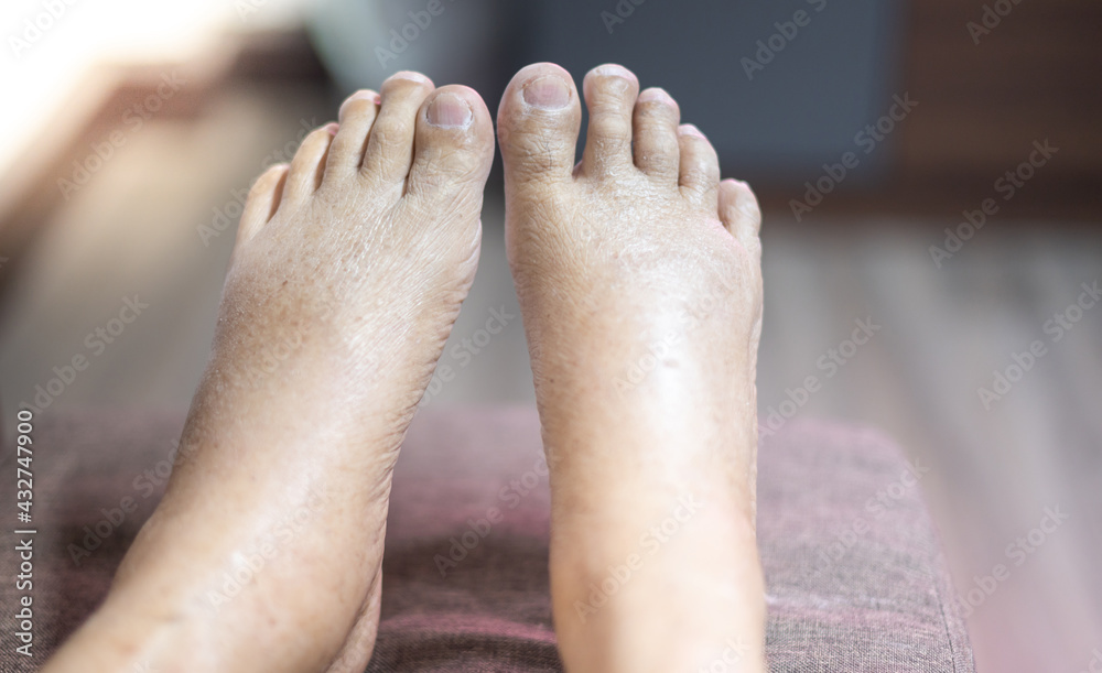 Fototapeta premium The feet of old man wrinkle skin swollen feet with the cancer and the body lack of the protein for health so not good.