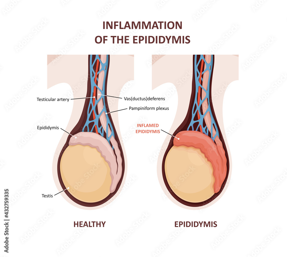 Inflammation of the epididymis. comparison and difference of Healthy ...