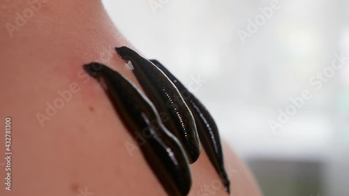 Three leeches on patient's neck, close-up. Hirudotheraphy concept. High quality 4k footage photo