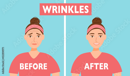 Woman face wrinkles before and after skin care treatment in flat design. Anti-aging therapy.