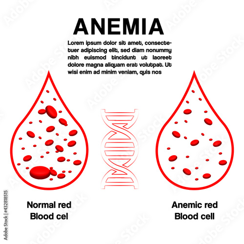 Infographic image of anemia. The difference between the number of red blood cells and the normal number of anemia. Realistic vector image of red blood cells or hemoglobin amount in human blood.Medical