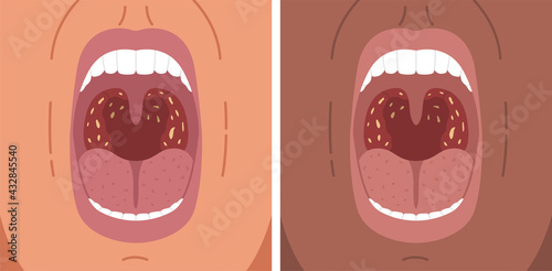 Vector illustration of bacterial tonsillitis, sore throat, tonsil stones.