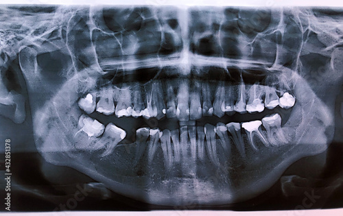 Close up panoramic x-ray of teeth and jaw person