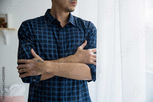 man hugs himself blue shirt hands vitiligo