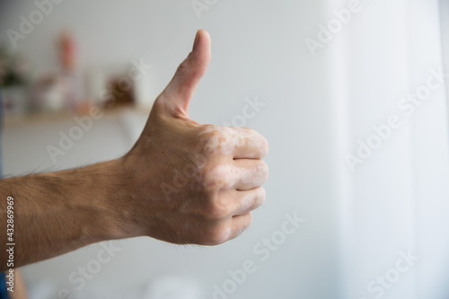 male vitiligo hand shows great class