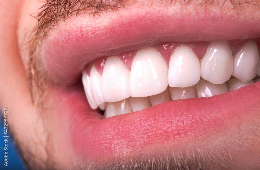 Obraz premium Perfect Close Up White beautiful Veneers Teeth bleaching crowns whitening young lady smiling, Male beard natural man smile. Dental zircon implants restoration surgery. Fashion concept