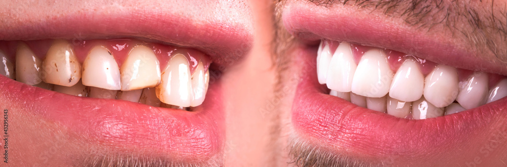 Obraz premium Perfect smile before and after veneers bleach of zircon arch ceramic prothesis Implants crowns. Dental restoration treatment clinic patient . Result of oral surgery procedure whitening dentistry