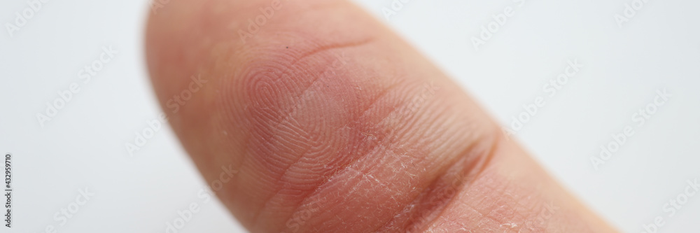 On finger there is red callus and an abscess On finger there is red callus and an abscess