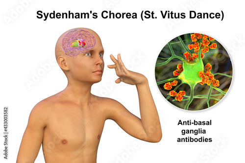 Anti-neuronal antibodies, anti-basal ganglia antibodies in a boy with chorea photo