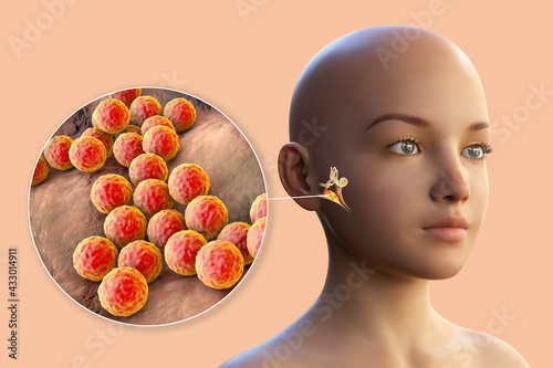 Staphylococcus aureus bacterium as a cause of otitis media photo