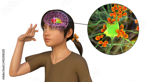 Anti-neuronal antibodies, anti-basal ganglia antibodies photo