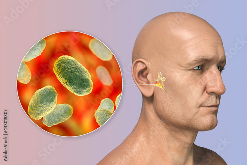 Haemophilus influenzae bacteria as a cause of otitis media photo