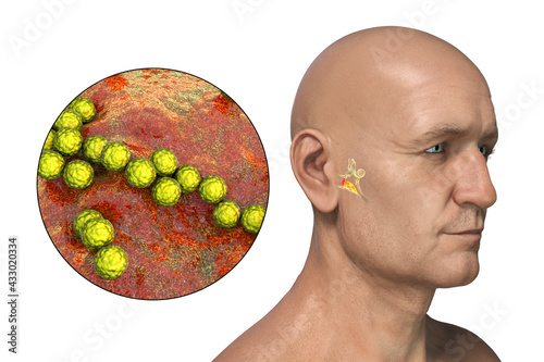 Streptococcus bacterium as a cause of otitis media photo