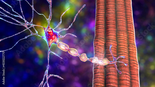 Demyelination of neuron, the damage of the neuron myelin sheath seen in demyelinating diseases