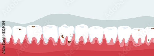 Jaw with teeth with caries in section.