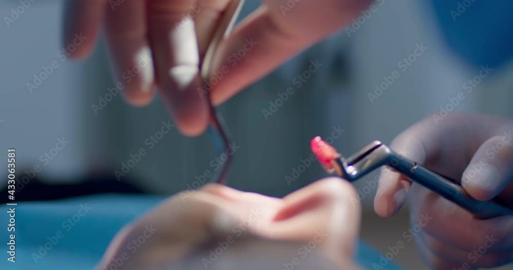 A female patient is laying in the dental chair while a dentist's hand is getting out from the mouth a pulled-out tooth by using dental forceps and laying it to the napkin. A female patient is laying in the dental chair while a dentist's hand is getting out from the mouth a pulled-out tooth by using dental forceps and laying it to the napkin.