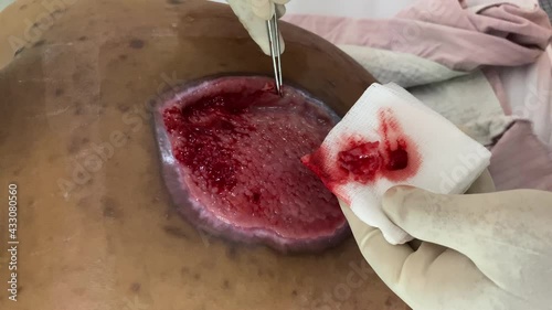 MALA, MALAYSIA - May 03, 2021: Malacca, Malaysia- 3 May 2021. 4k video of removing fibrin layer at wound bed to encourage granulation tissue. photo