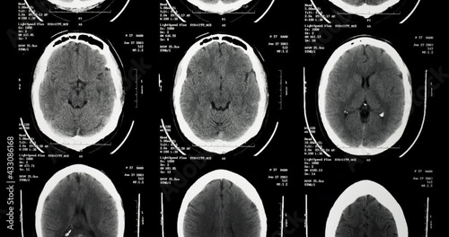 Medical Radiography X-Ray of a human Brain photo