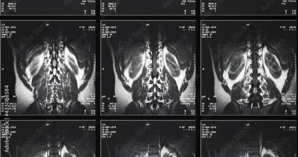 Medical Radiography X-Ray of a human torso 素材庫影片 | Adobe Stock