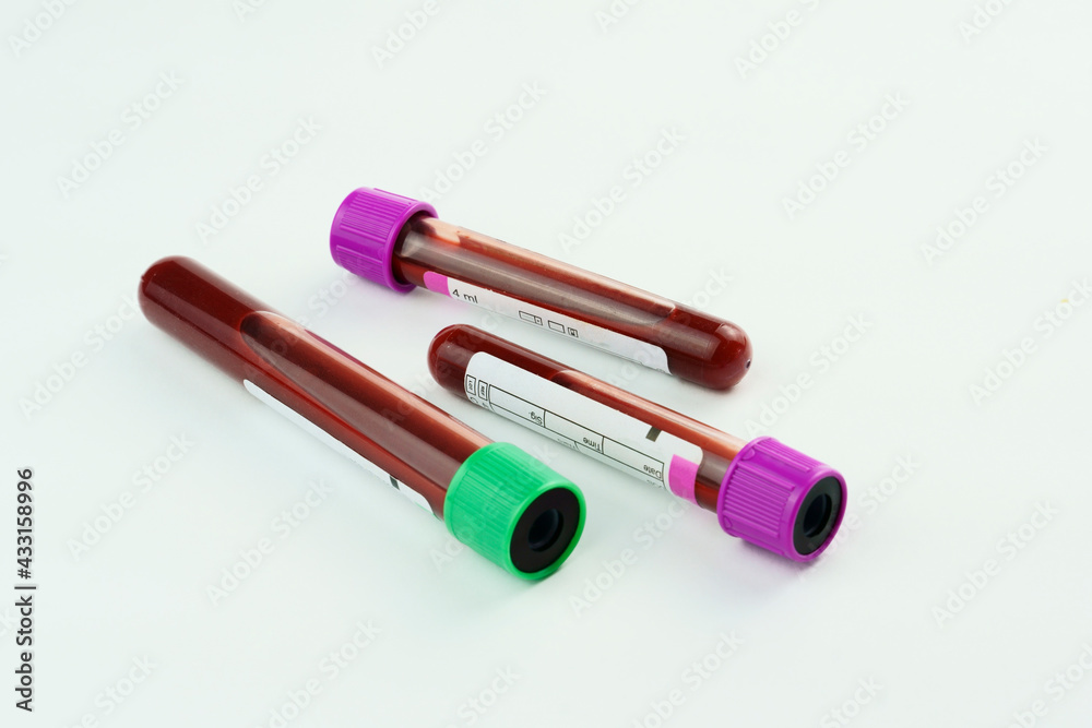 Vacuum tubes for collection and blood samples on white background..Transparent with purple and green lid. Label to identify the data. Selective focus. Vacuum tubes for collection and blood samples on white background..Transparent with purple and green lid. Label to identify the data. Selective focus.