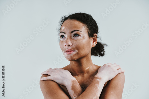Canvastavla Beautiful woman with vitiligo skin posing in studio