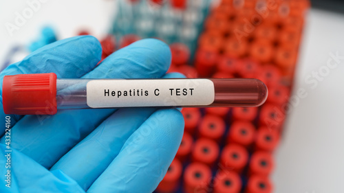 Hepatitis C virus (HCV)  test result with blood sample in test tube on doctor hand in medical lab photo