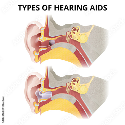 Hearing aid, in-ear sectional view, different types of devices