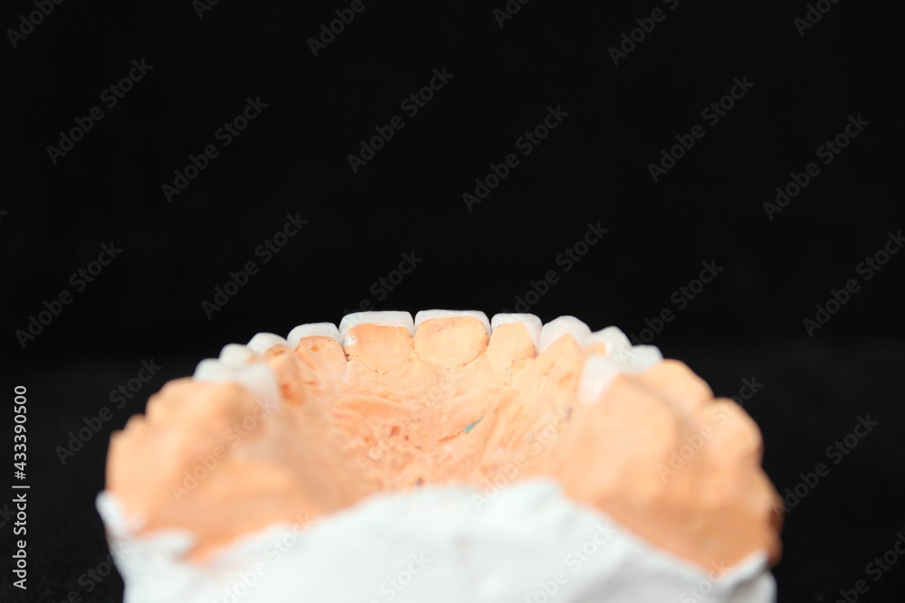 custom made wallpaper toronto digitalDental veneers in the plaster model. Smile makeover