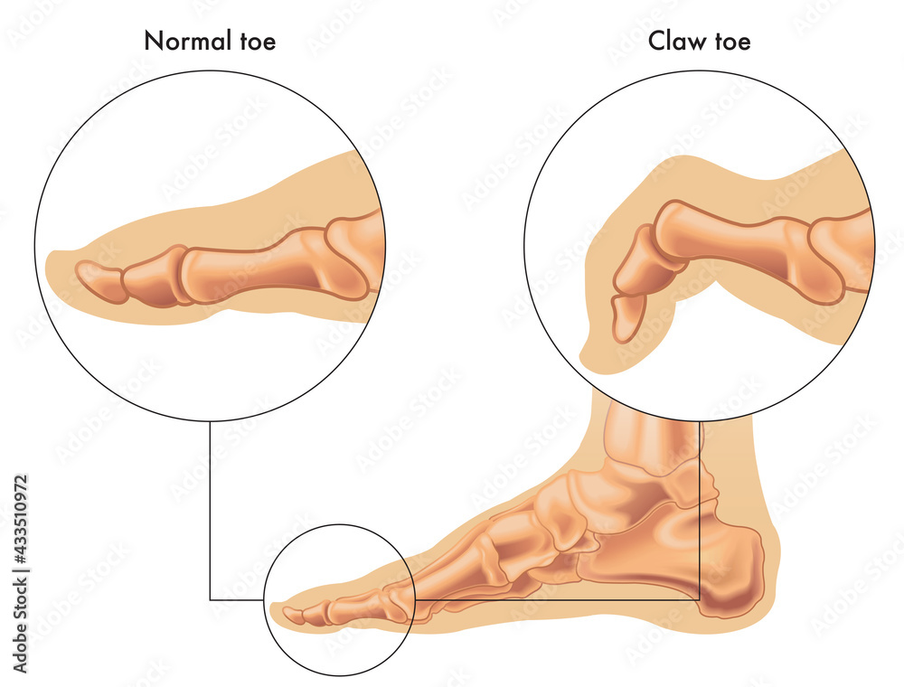 Medical illustration shows the difference between a normal toe and a claw toe, with annotations