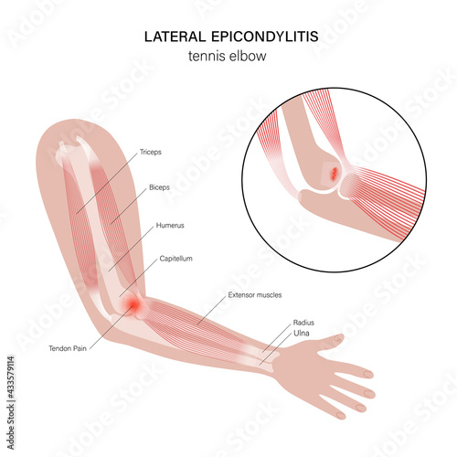 Lateral epicondylitis tennis elbow