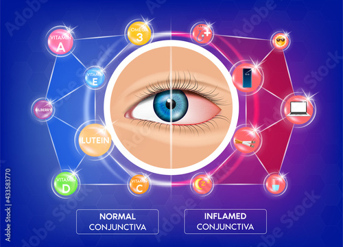 Normal conjunctiva and Risky behaviors for eye inflammation (Conjunctivitis). Nourish the eyes with vitamins, omega 3, lutein. Human eye anatomy in front view. 3D Vector EPS10 illustration