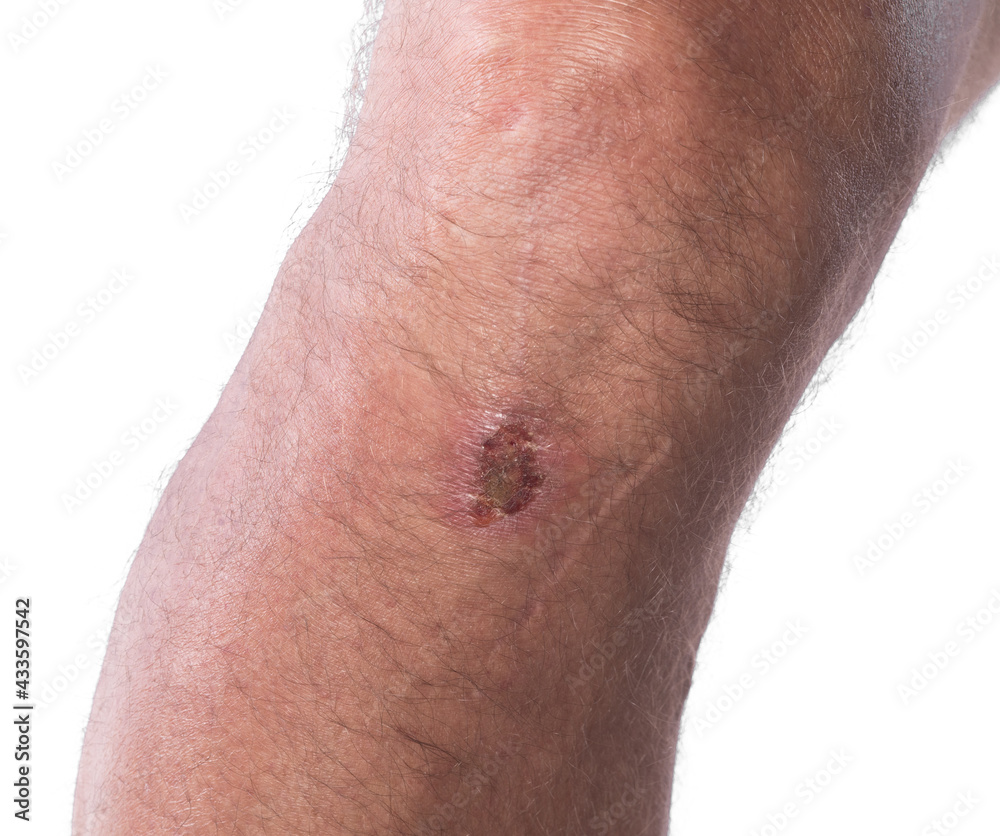 Fototapeta premium male sore knee isolated on white background