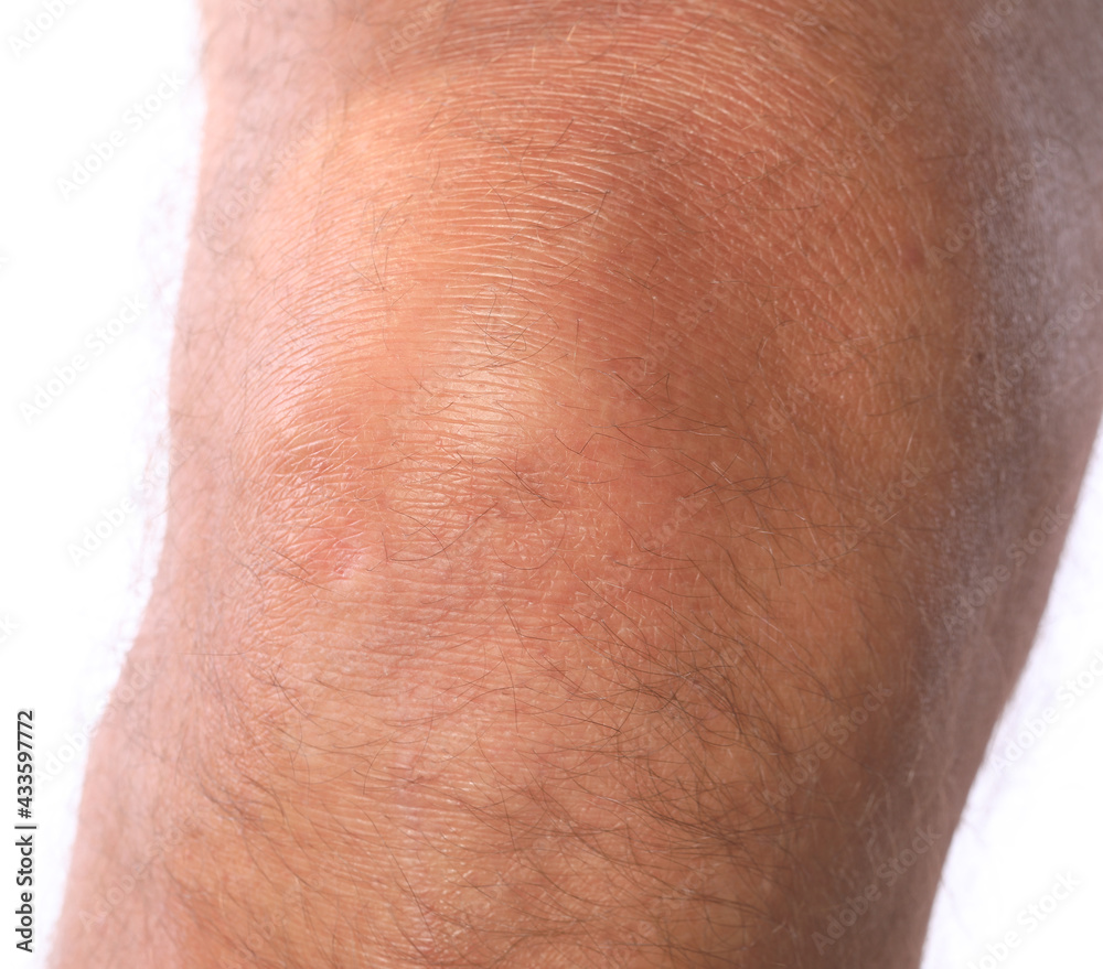 Fototapeta premium male sore knee isolated on white background
