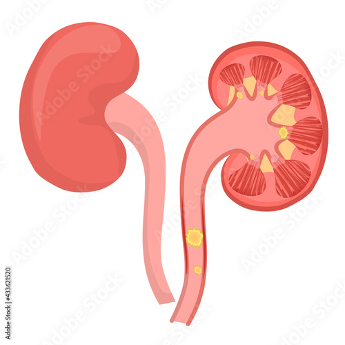vector illustration of kidney stones isolated on a white background.The concept of kidney disease